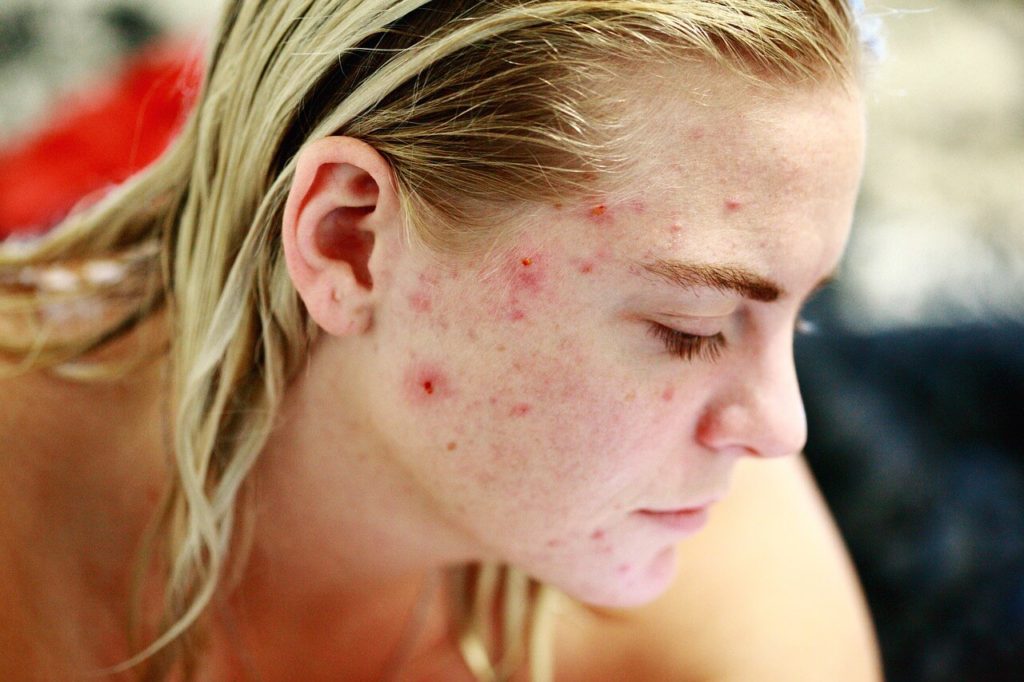acne pimples on skin