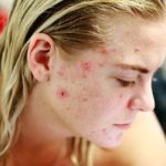 acne pimples on skin