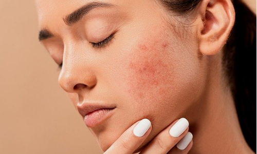 Acne cure