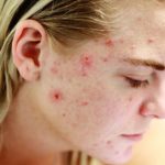 best blackhead remover tools